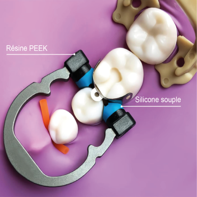 Anneau  Nickel Titanium , SMALL/BLUE,  prémolaire/petite couronne