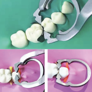 Anneau nickel-titane pour maintien de matrice